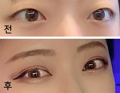 [目] 屋根S2 - 目頭切開、眼瞼下垂手術