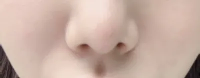 [アンチエイジング] ウォニvv - 脂肪移植