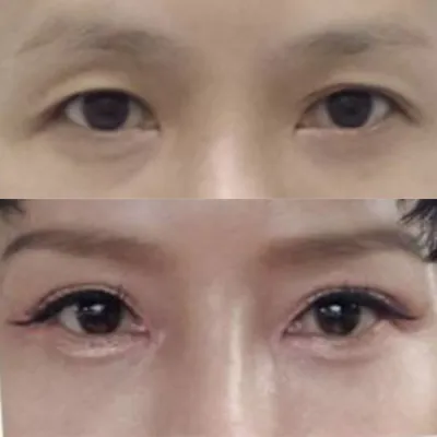 腫れもすぐに引いて、うまくいったようです