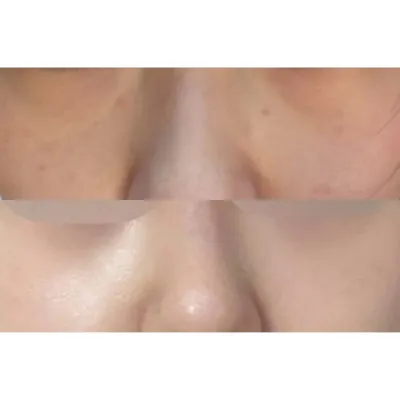 シム・ジョンファン院長に目の下の脂肪再配置手術を受けました!