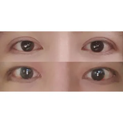 二重ライン縮小再手術＋目つき矯正から10日後（男性）