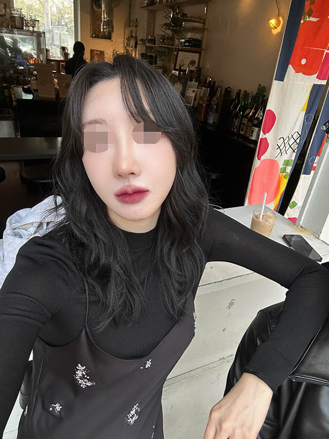 김현우원장님께 코재수술 (자가늑) 받은 후기에용