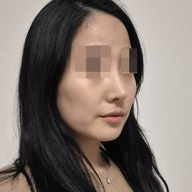 처음 코수술 원트에서 받았답니다! (수술 5개월차)