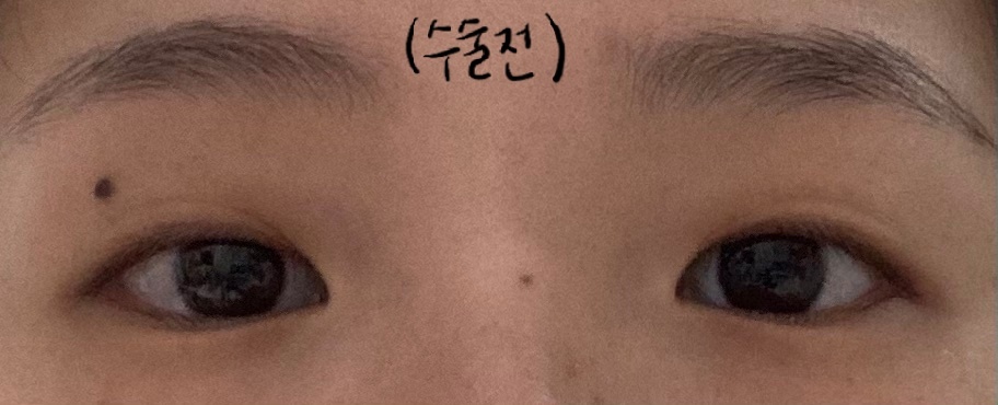 埋没+目頭切開レビュー