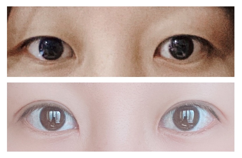 二重手術3ヶ月後のレビュー