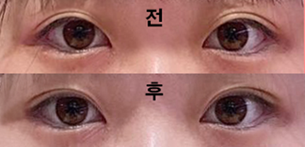 埋没で手術しました！