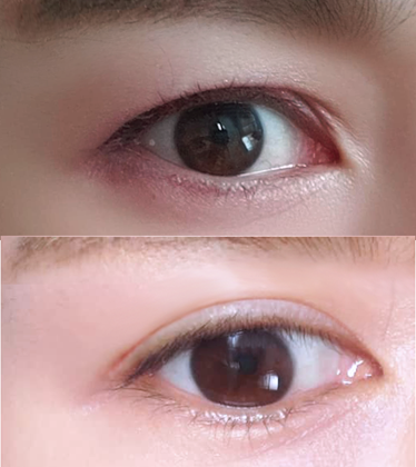 切開による目つき矯正に満足！