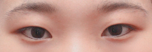 切開二重と目頭切開手術して一ヶ月