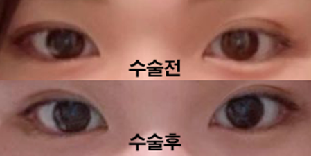 二重再手術3ヶ月目です!