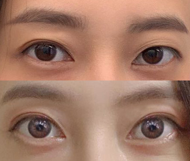 再手術6ヶ月目のレビュー