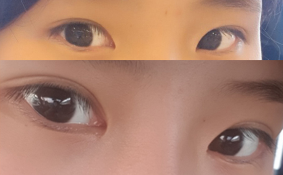 目頭切開、二重再手術2ヶ月後のレビューです～