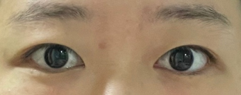 切開二重と目頭切開 5ヶ月目のレビューです