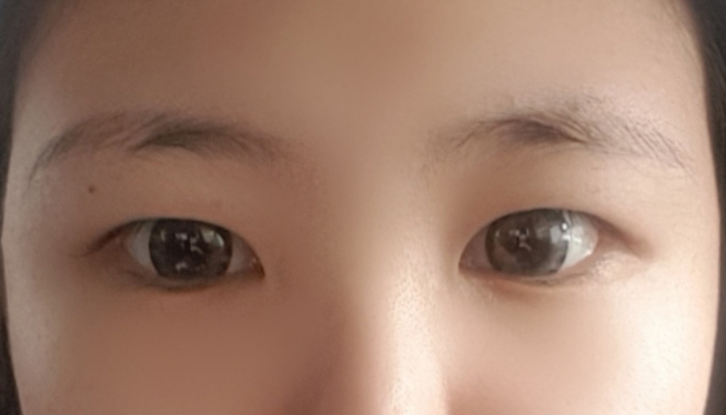 切開式目つき矯正4ヶ月目