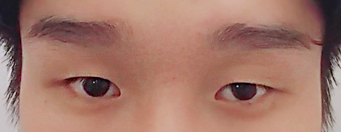 二重なし目つき矯正、目頭切開2週間..