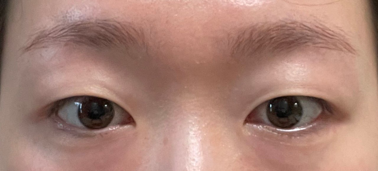 시술 전이랑 시술 후랑 인상이 많이 달라졌는데 매우 만족하고 있습니다 ≡