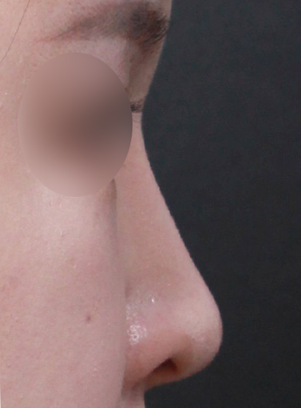 여기서잘한거같아서 친구들한테꼭 추천할거에요!!! 꼭 수술은  임영민원장님께 ㄱ ㄱ