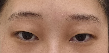 쌍수 고민하시는 분들은 여러군데 다니지 마시고 베리굿성형외과로 상담받으러오세용(ⓐⓐ) °◇°