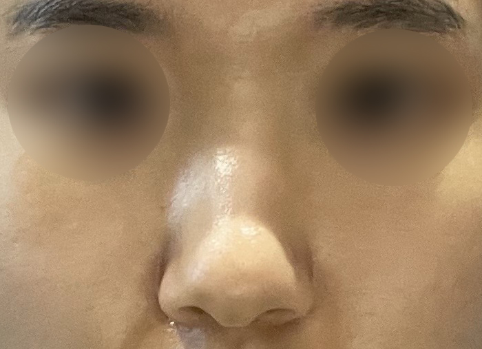 수술 후 2달이 지난 지금 너무 만족하고 부작용도 하나도 없어서 잘 지내고 있답니다.