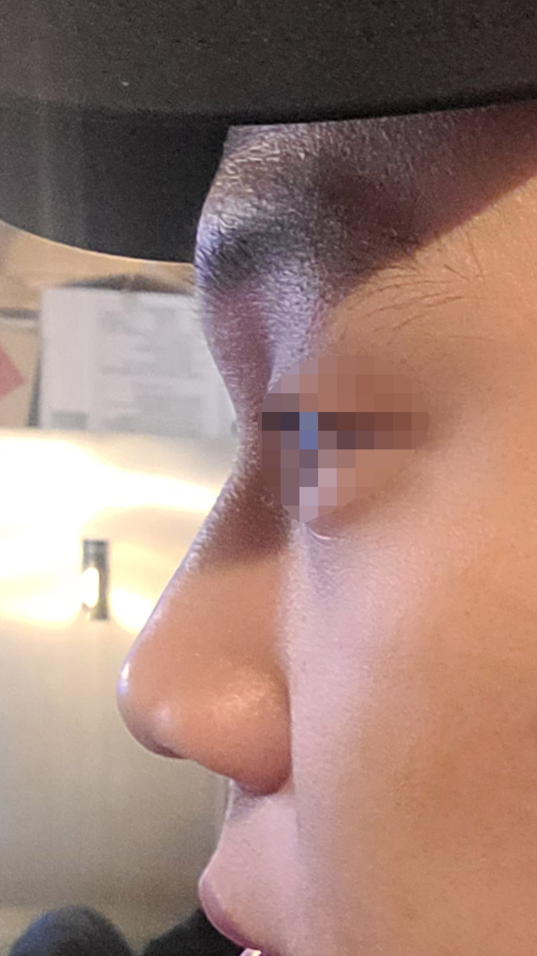 남자 코 정말 잘하십니다. 베리굿성형외과 추천드립니다.