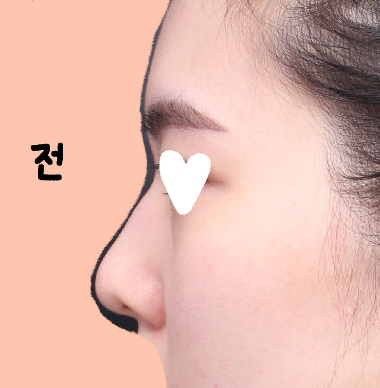 베리굿 성형외과에서 코성형(첫코) 수술한지 벌써 2주차에요!