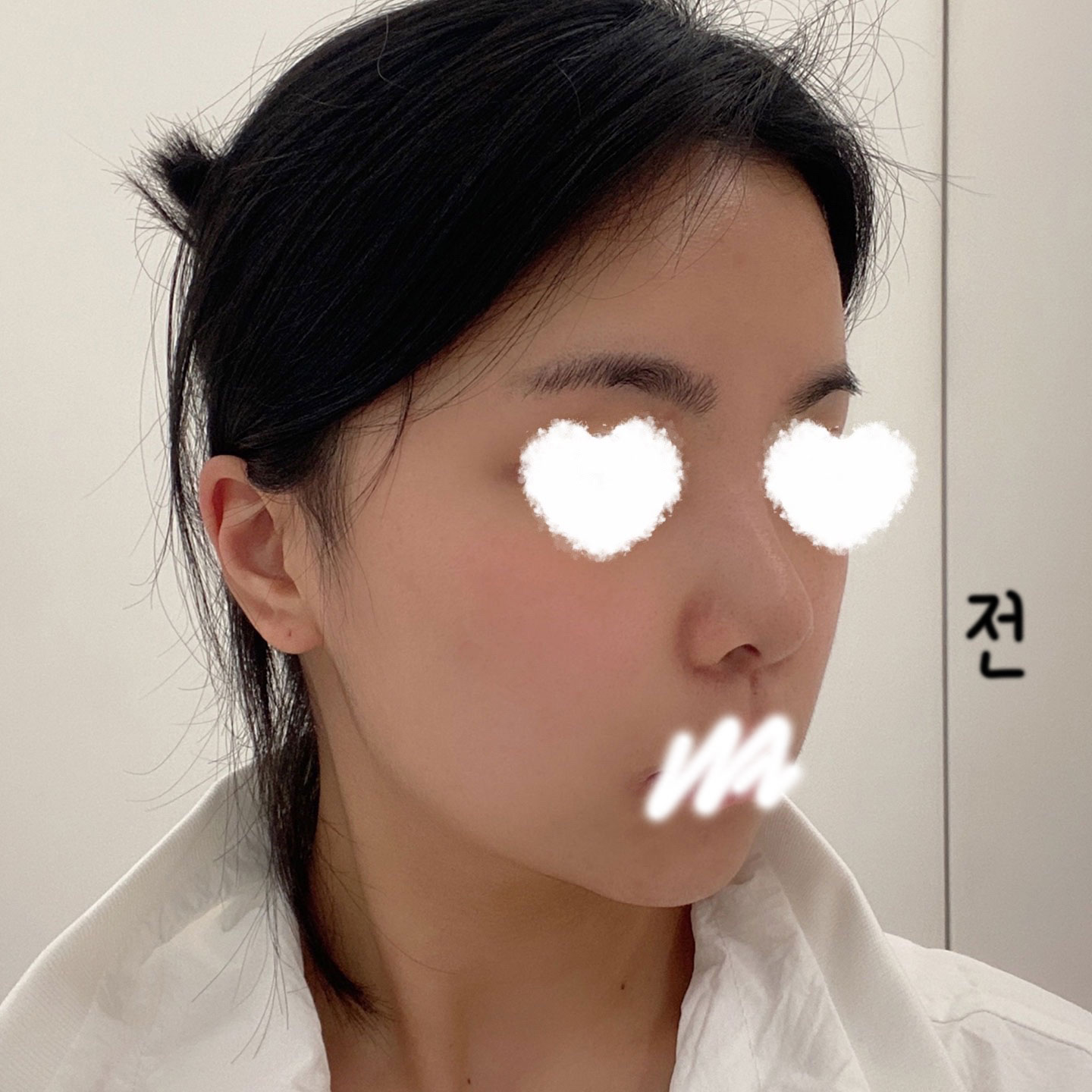 ​베리굿성형외과에서 했고 5개월 됬어요 ㅎㅎ