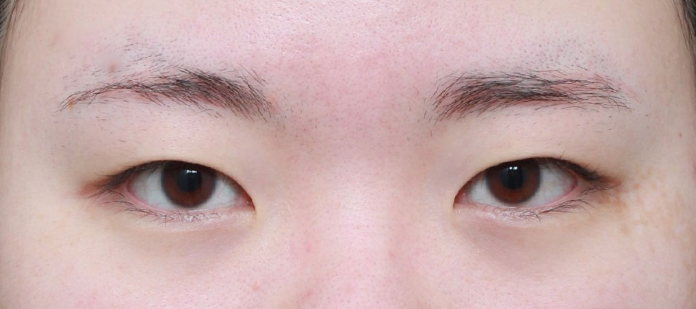 이번에 무쌍이였던 제가 눈성형(첫눈)을 했습니당..