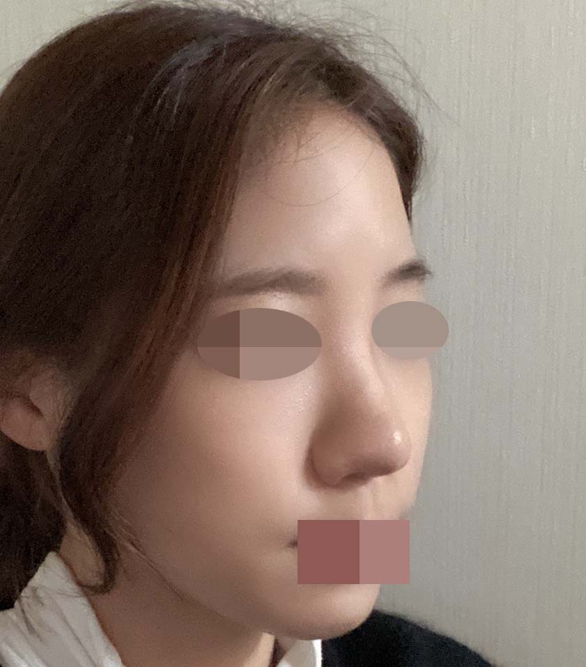 코필러만 맞으시는 분이나 코수술 고민하시는 분들 꼭 고민하지  마시고 수술 추천입니다! 임원장님 증말증말 추천해드려요!!