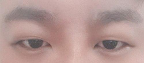 비절개눈매교정 수술했어요