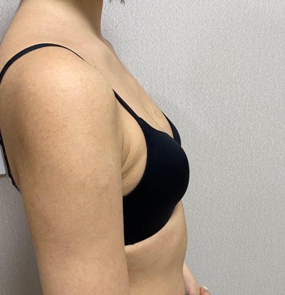 가슴 확대술 벌써 3주차에용!!!!!!!!!