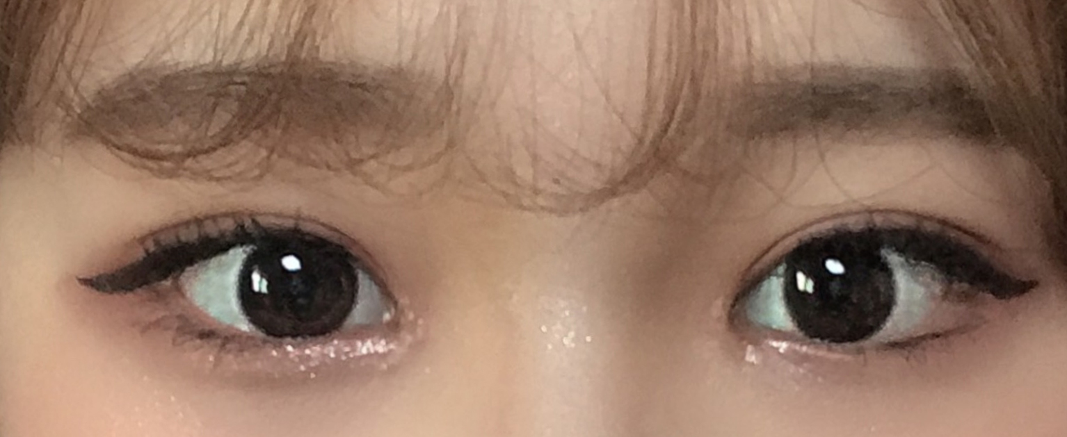 베리굿 성형외과에서 자연유착,앞트임 받았어요!