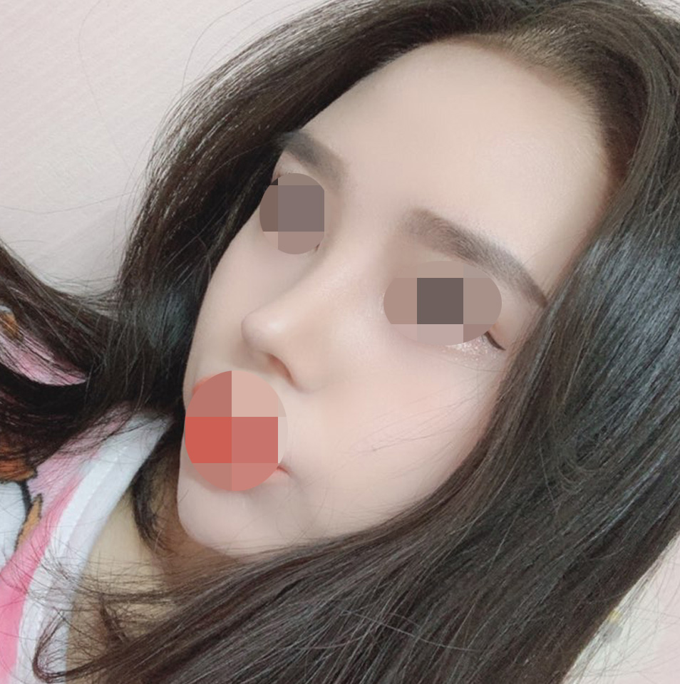 첫코,콧대,코끝,짧은코,콧볼축소 했습니당