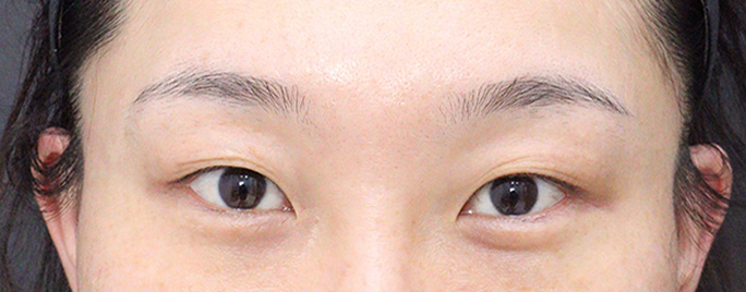 다들 쌍수는 베리굿 성형외과에서 하세요ㅠㅠ!!!