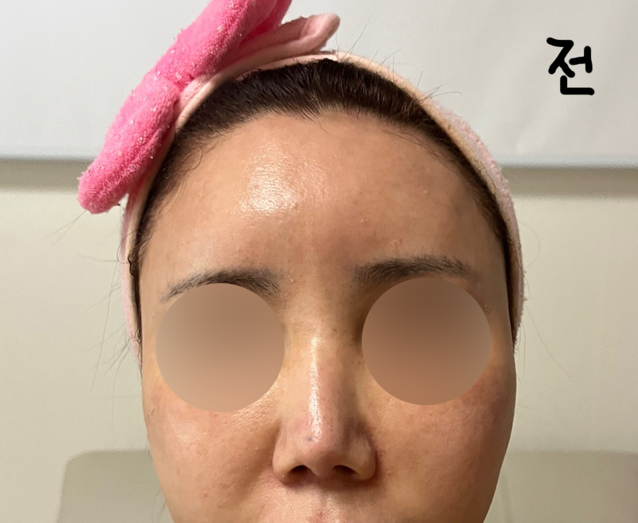 짧은코재수술후기