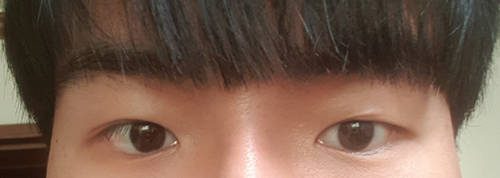 눈 재수술 수술후기