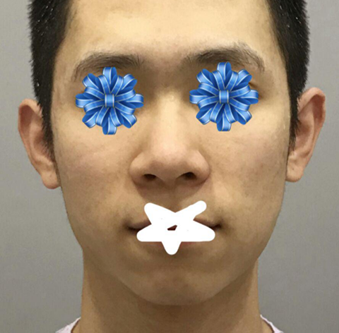 코 | 안면윤곽 수술후기