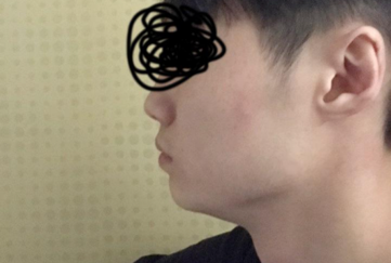 안면윤곽 | 기타 수술후기