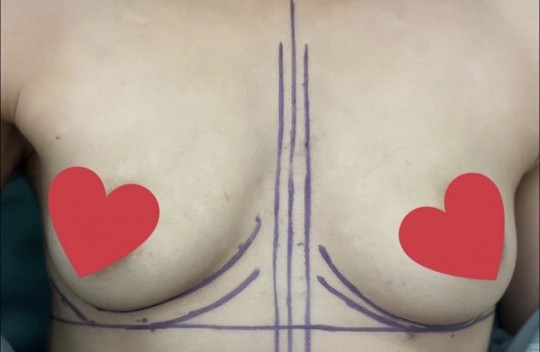 심한 새가슴 5개월차~ 하길 잘 했어요!