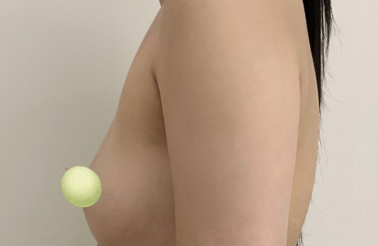 제 흉터가 제일 작고 안 보여요 ㅋㅋ