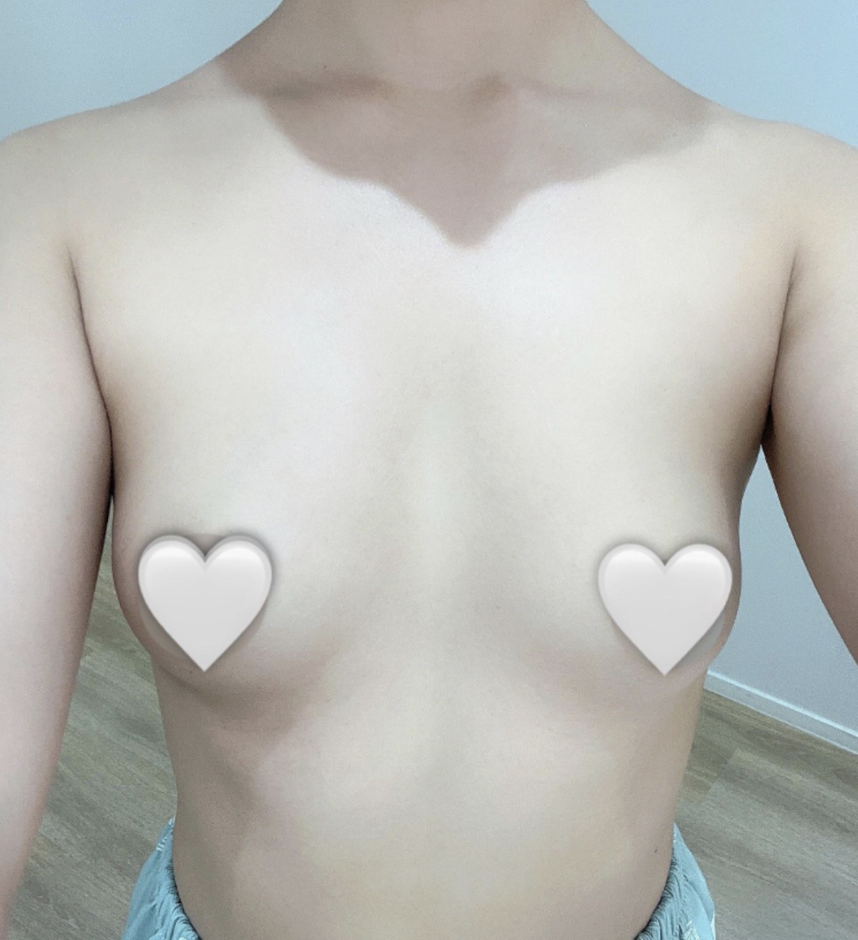 멘엑+부유방 제거) 1개월 대만족 후기