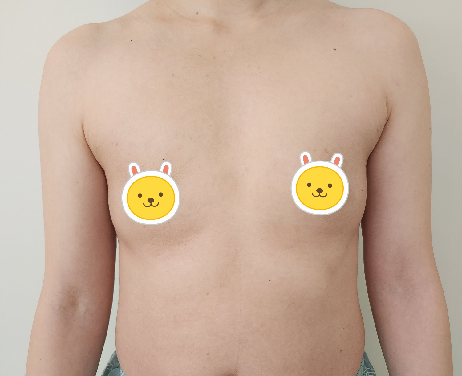 [재수술] 멜론 가슴 1주일차!