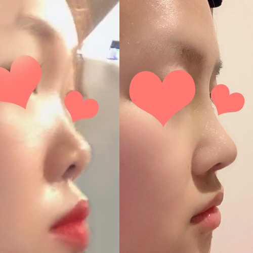 鼻の手術レビュー!!