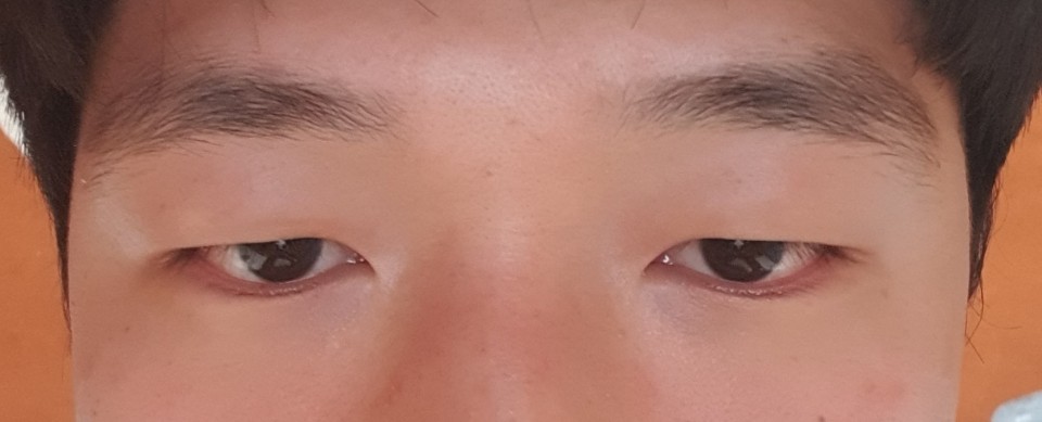 切開式目つき矯正