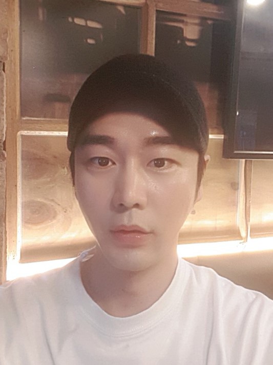 糸リフティングと額脂肪移植を受けました〜