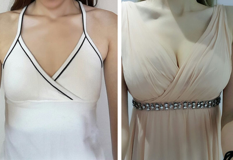 豊胸手術のレビューです～