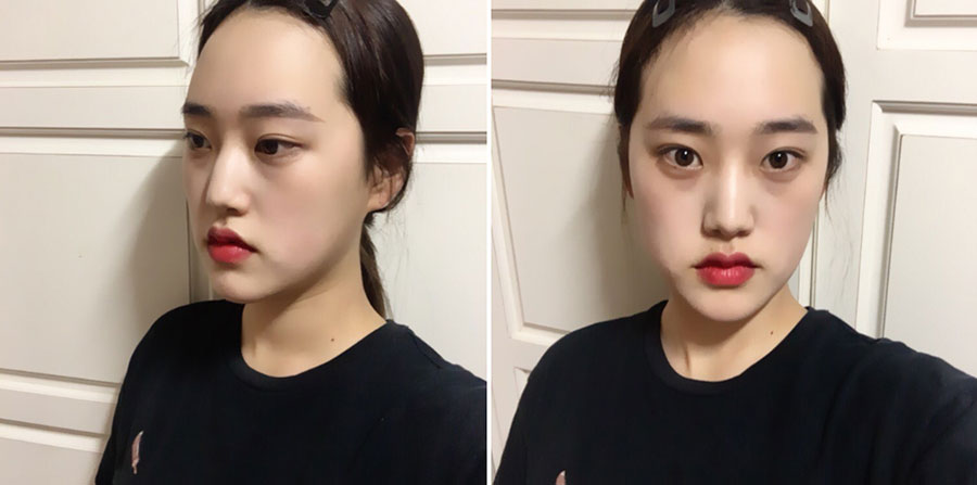 エラ縮小、顎先、皮質骨切除術、鼻の手術を受けました！==== 3333