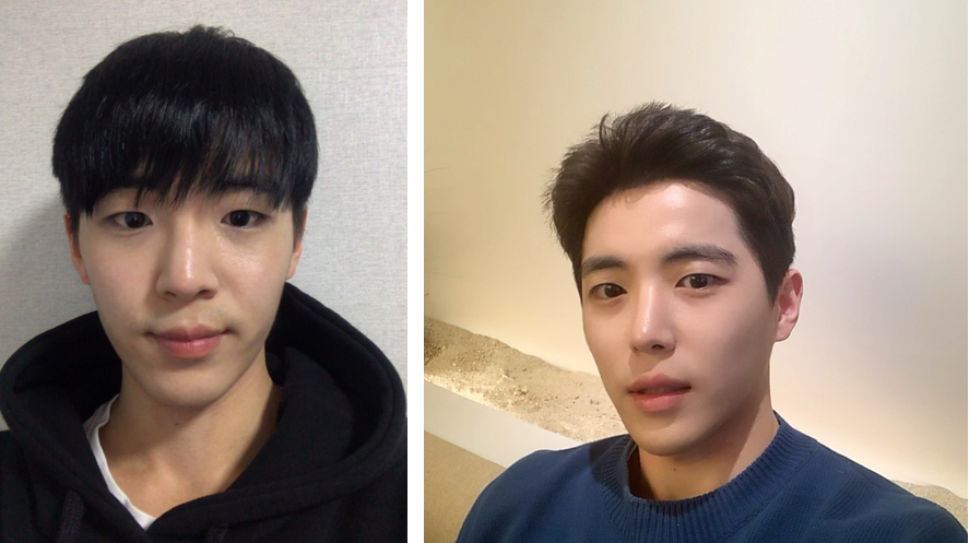 目つき矯正と切開、鼻の手術をしました。