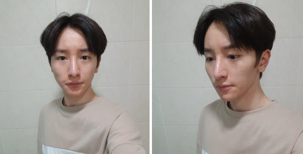 輪郭矯正、鼻整形、フルフェイス脂肪移植