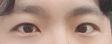 男性の目つき矯正（目頭切開含む、切開）を受けました〜！！