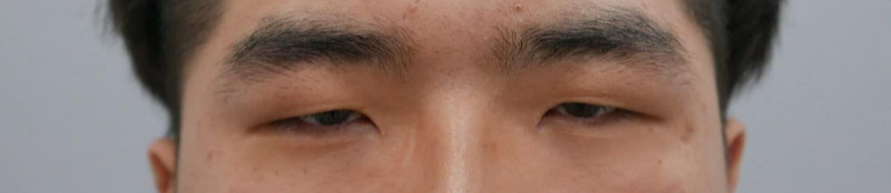 二重（切開）、目つき矯正、目頭切開