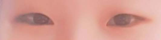 ジェイジュン美容外科でパク・ヒョンジュン院長に二重まぶた、目つき矯正手術を受けました!!